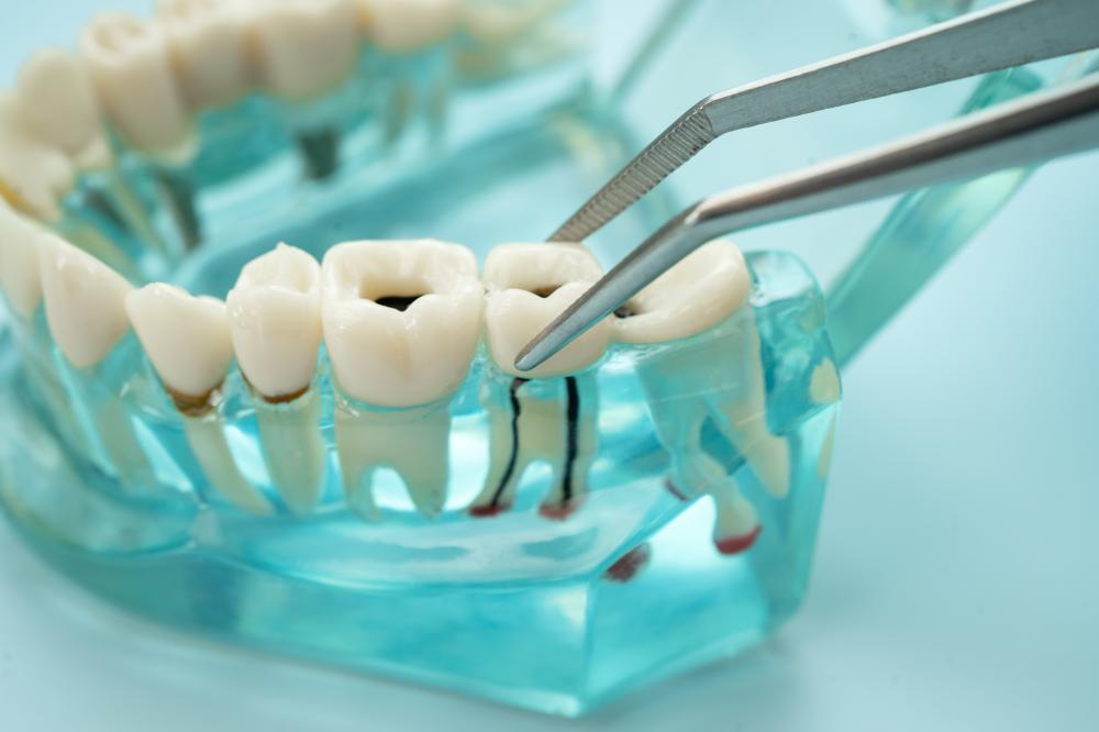 The Varieties of Dental Bridges