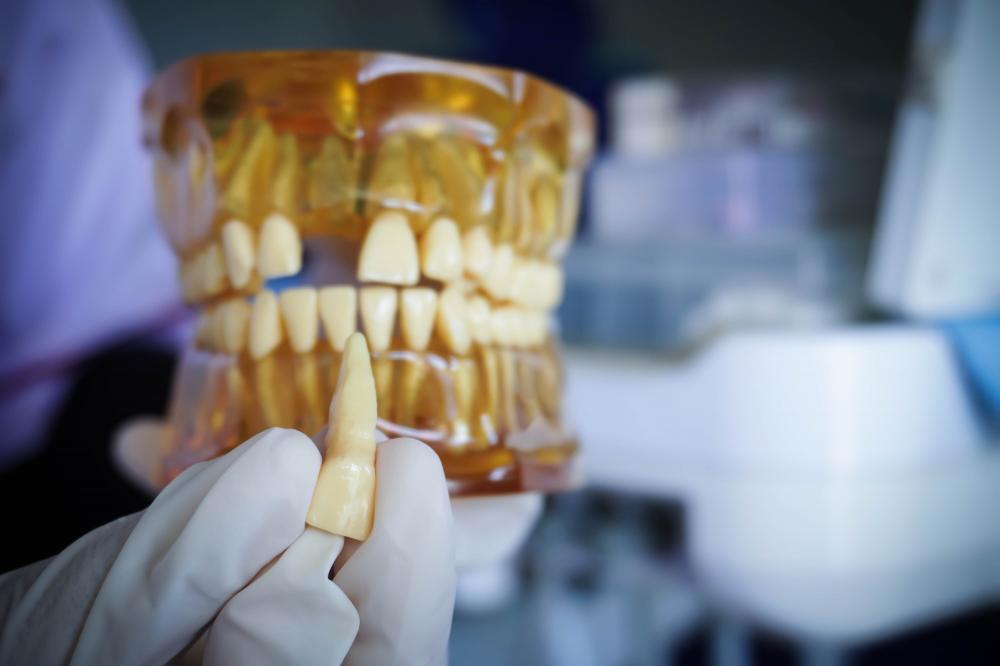 Importance of Dental Crown Warranty