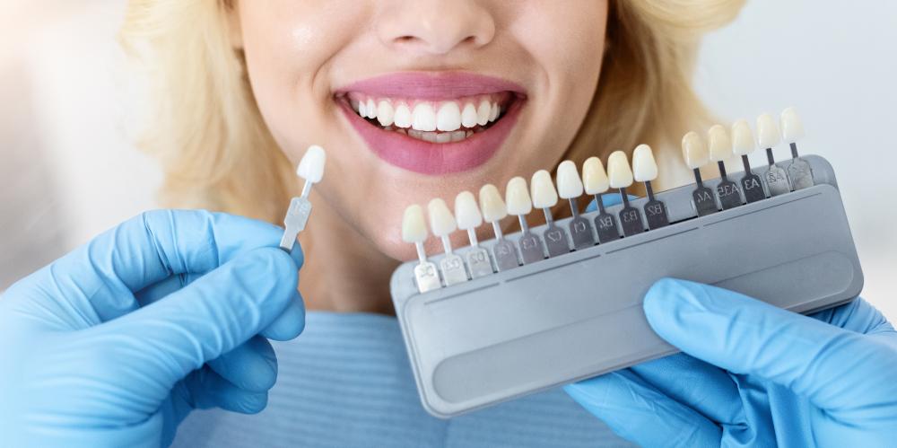 Benefits of Choosing Dental Veneers
