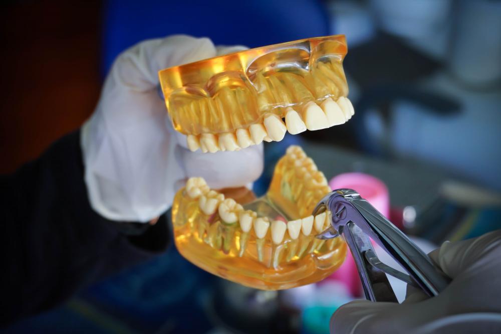 What is All on Four Dental Implants?