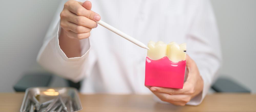 What is the Procedure for Getting a Dental Crown?