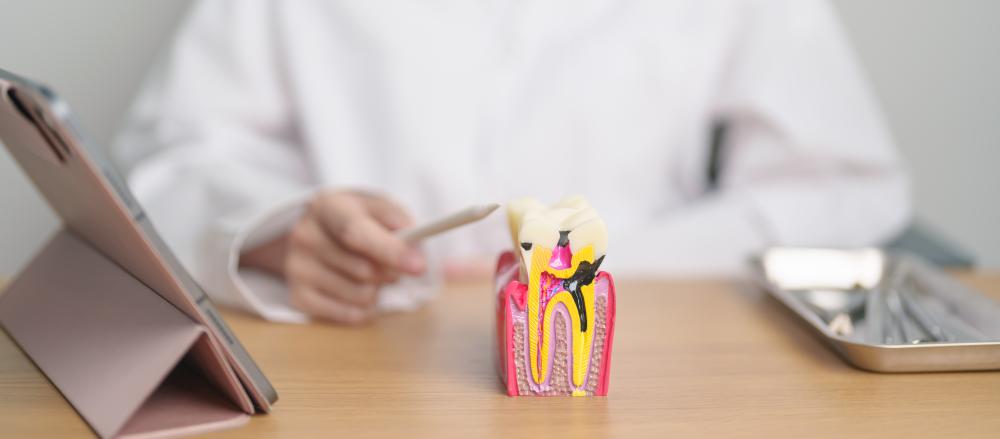 Signs You May Need a Root Canal