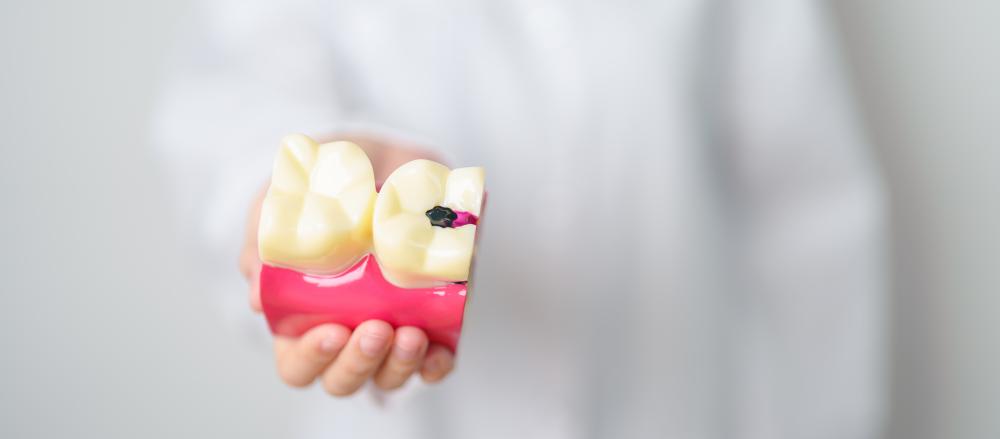 What is a Dental Filling Warranty?