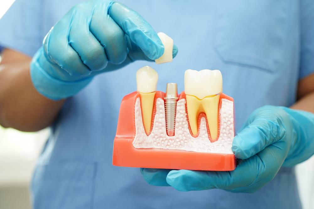 Cosmetic Considerations in Tooth Replacement