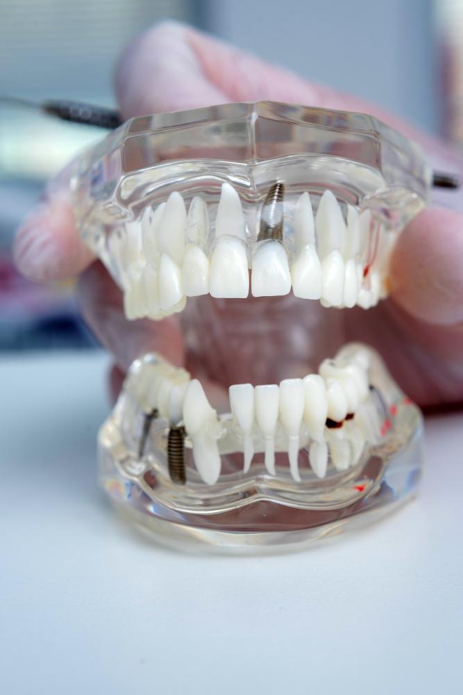 Skilled dental practitioner with dental implant model