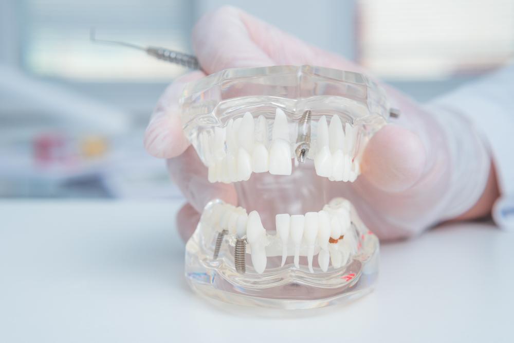 Orthodontist with dental implant model emphasizing the cost of whole mouth dental implants