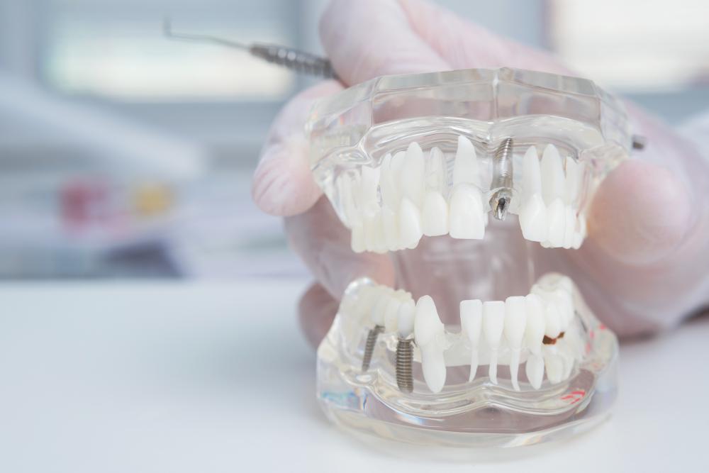Orthodontist holding model of teeth with dental implants