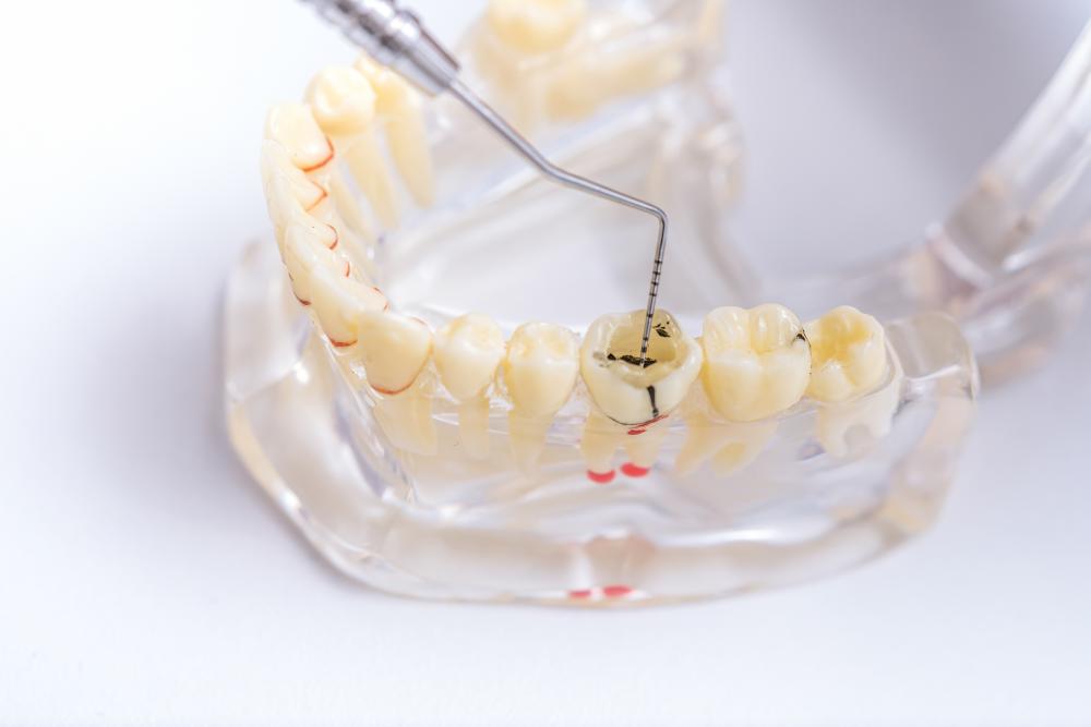 Expert orthodontist demonstrating dental caries treatment instrument