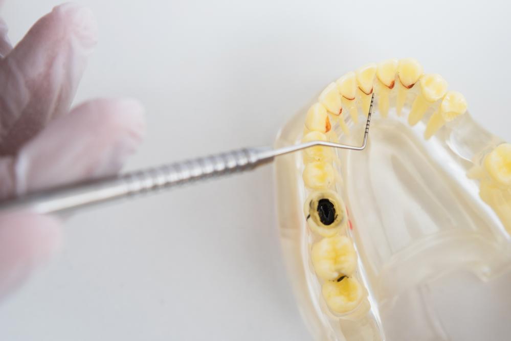 Orthodontist demonstrating dental instruments for gingivoplasty procedures