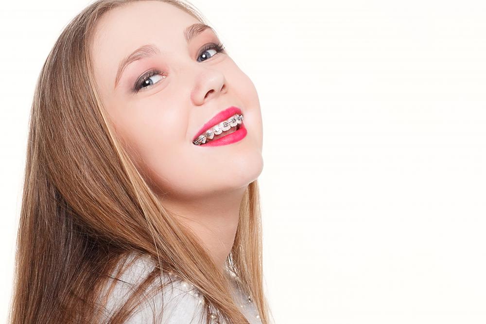Benefits of Clear Braces