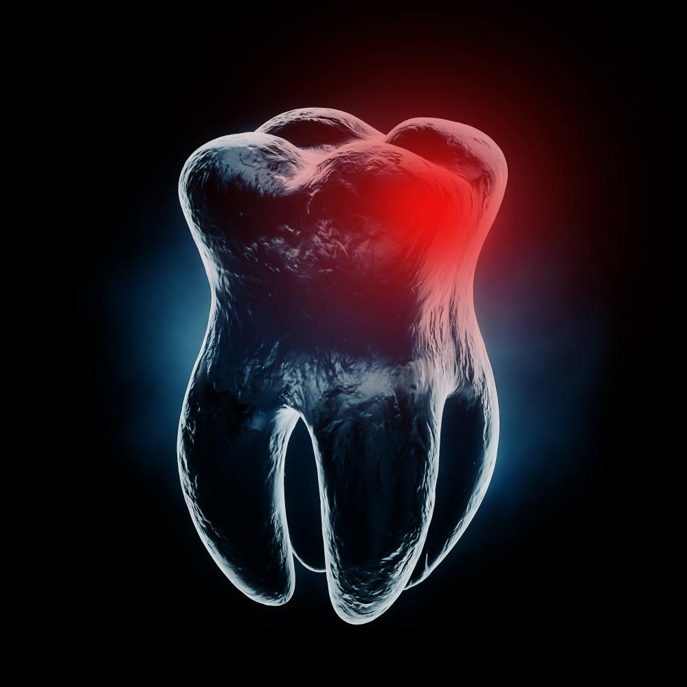 X-ray view of an aching tooth highlighting the need for emergency extraction