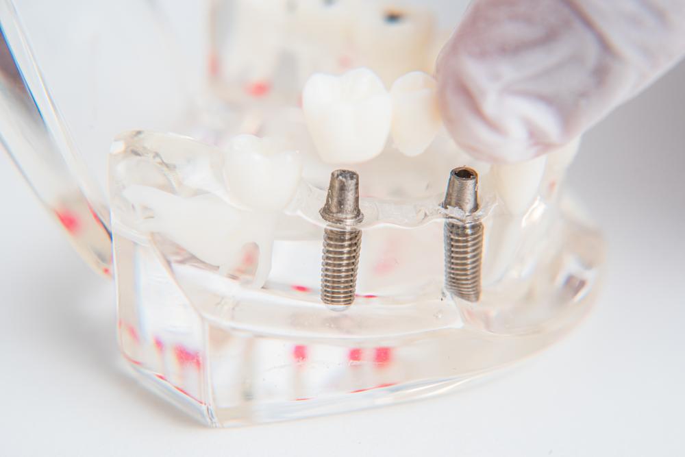 Orthodontist demonstrates dental implant insertion technique