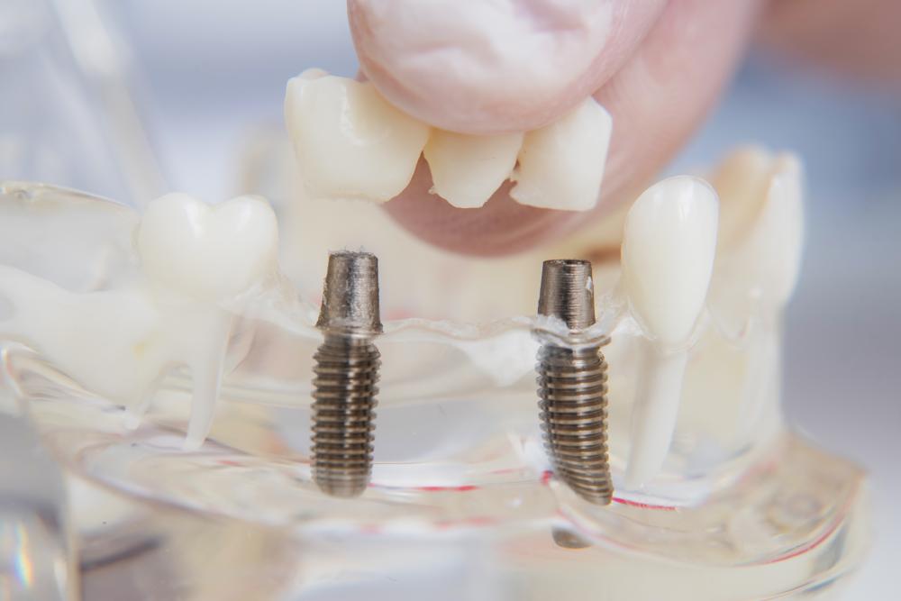 Orthodontist demonstrating dental implant procedure for Jupiter FL patients