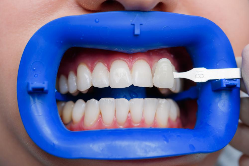 Professional teeth shade comparison in NE Calgary Dental Centre