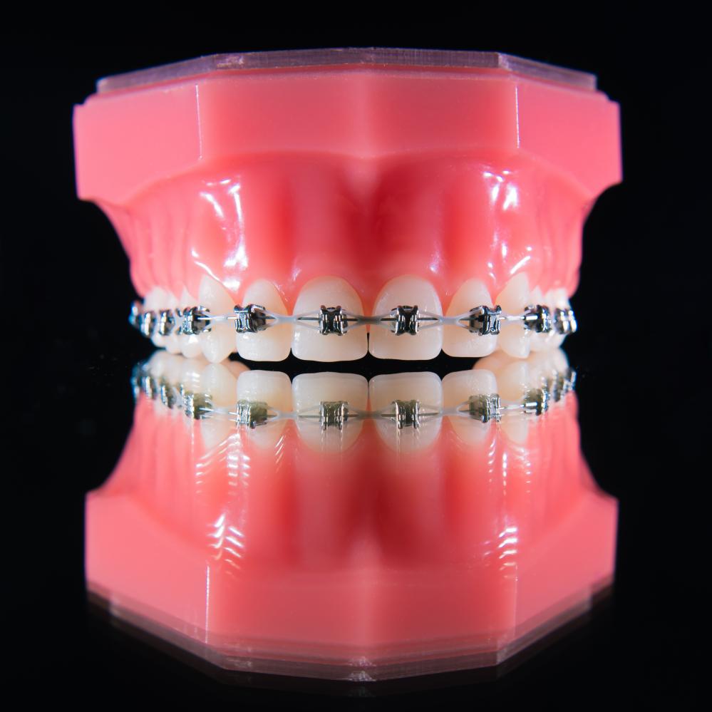 Orthodontic braces on model teeth, exemplifying advanced dental treatment options