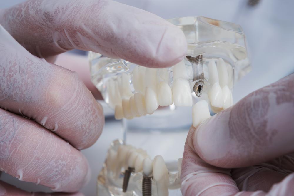 Orthodontist showcasing a model of teeth with dental implants