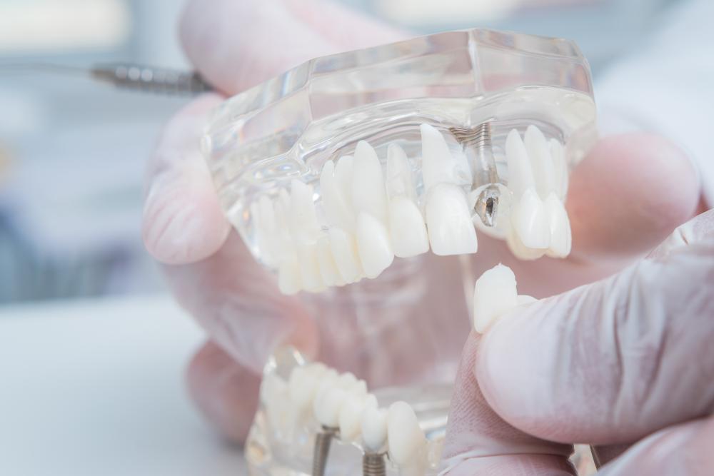 Orthodontist showcasing a dental implant model