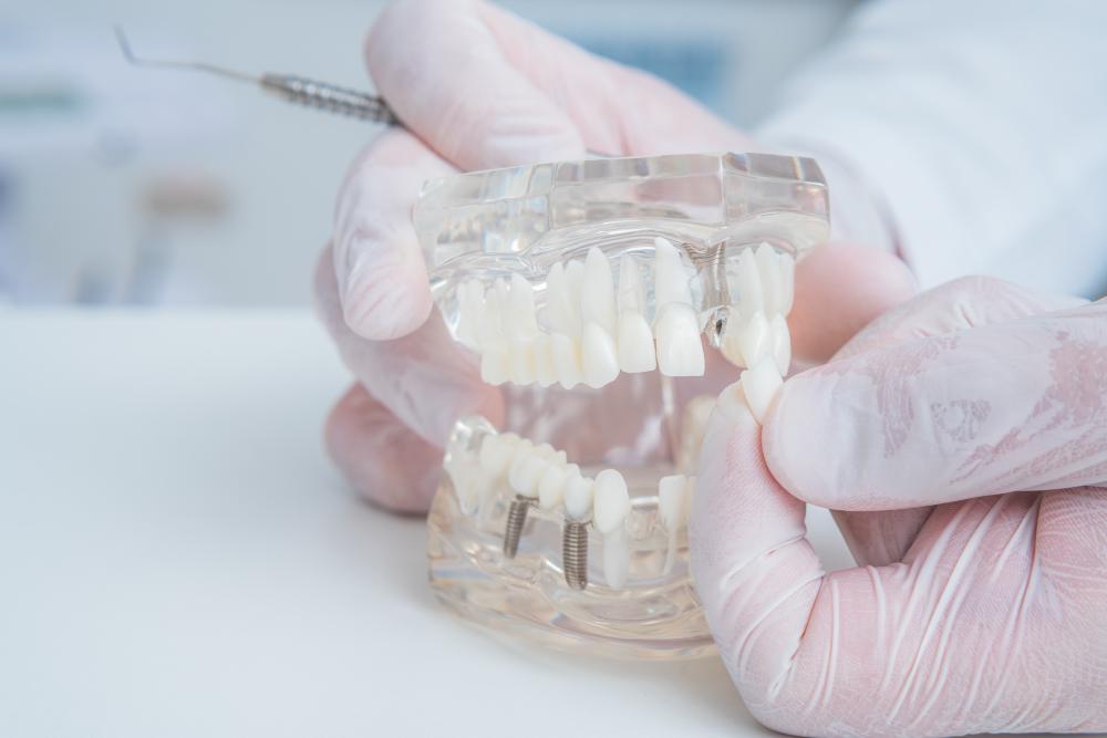 Orthodontist holding dental implant model showcasing teeth restoration