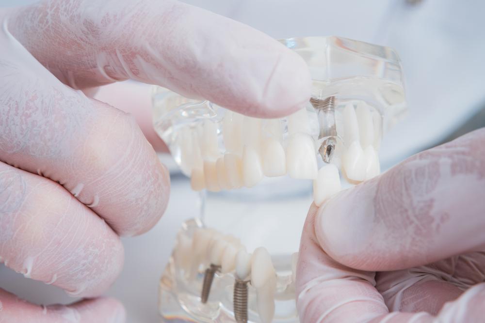 Close-up of dental implant model held by orthodontist, symbolizing expert implant care