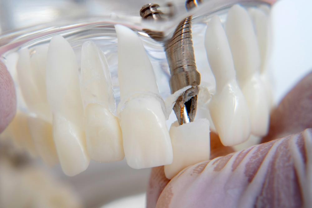 Orthodontist showcasing a model with dental implants, highlighting advanced dental restorative solutions