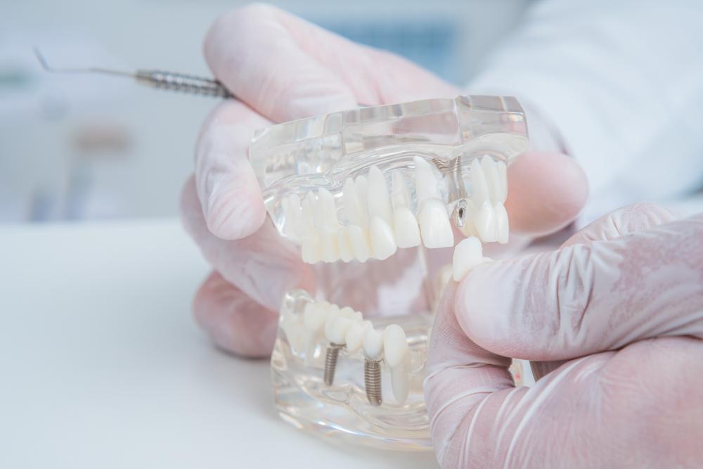 Orthodontist holding model teeth with dental implants in Philadelphia