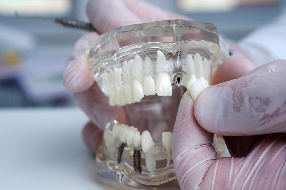 Orthodontist presenting a teeth model with dental implants