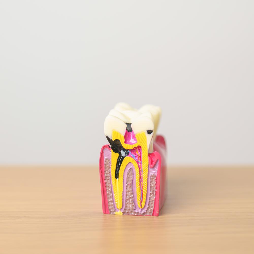 What Qualifies as a Root Canal Port Coquitlam Emergency?