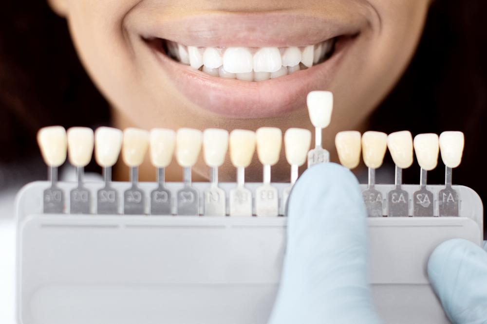 The Benefits of Choosing Veneers