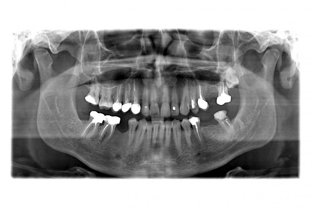 Why Choose Bensonhurst Dental for Full Mouth Dental Implants?