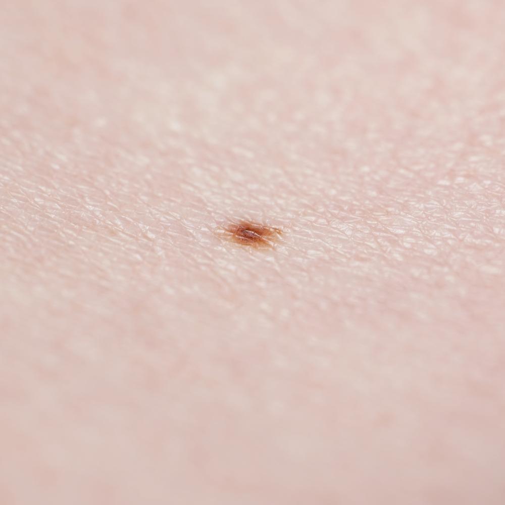 Why is Carrolwood a Preferred Choice for Melanoma Treatment?