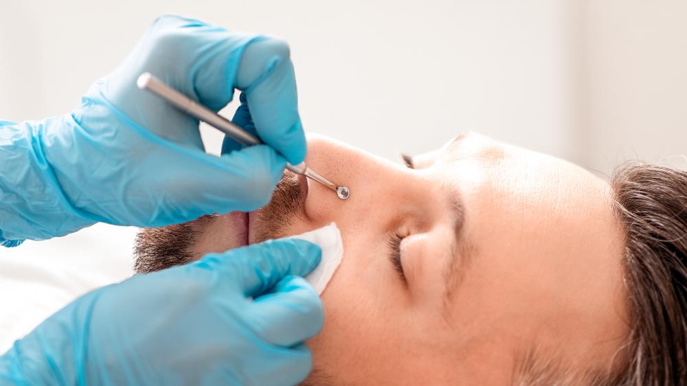 Is Mohs Surgery in Tampa Right for You?