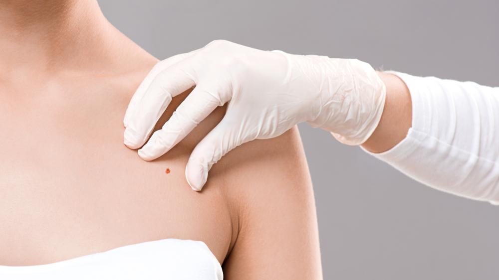 Choosing a Melbourne FL Melanoma Dermatologist