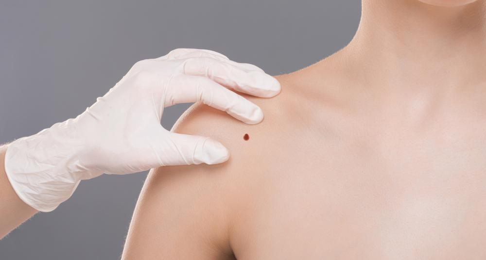 How to Perform a Self Skin Exam at Home