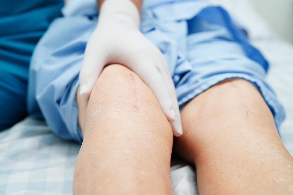 Vein Removal Options