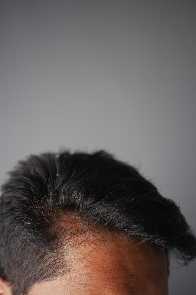 Emerging Trends in Hair Restoration
