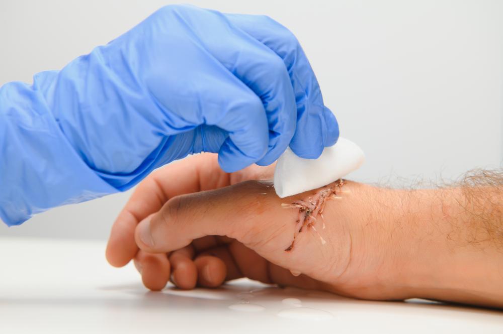 The Importance of Proper Wound Debridement