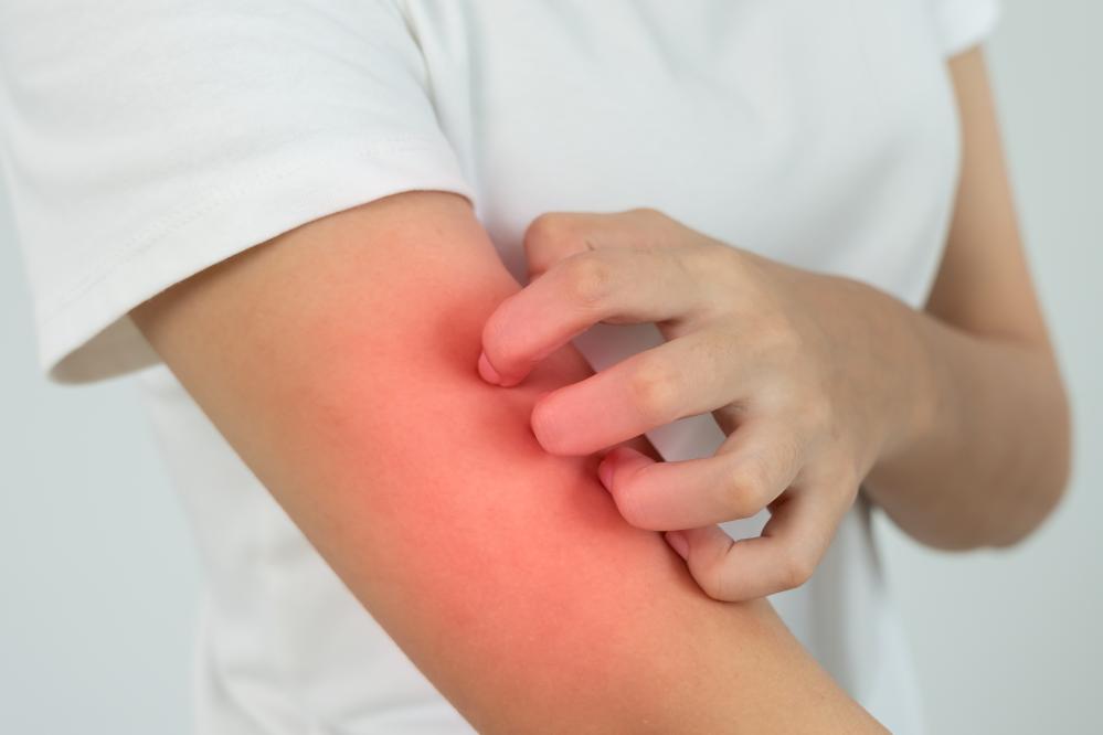 What Are the Signs You Need to See an Eczema Doctor?