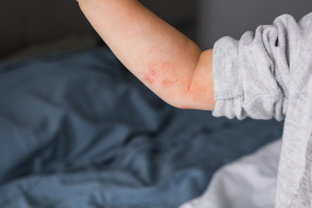 Exploring Treatment Options for Eczema