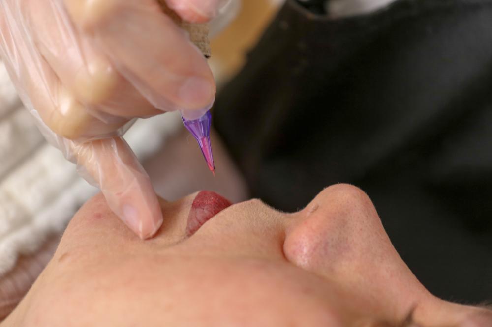 Benefits of Exosome Therapy in Microneedling Treatments