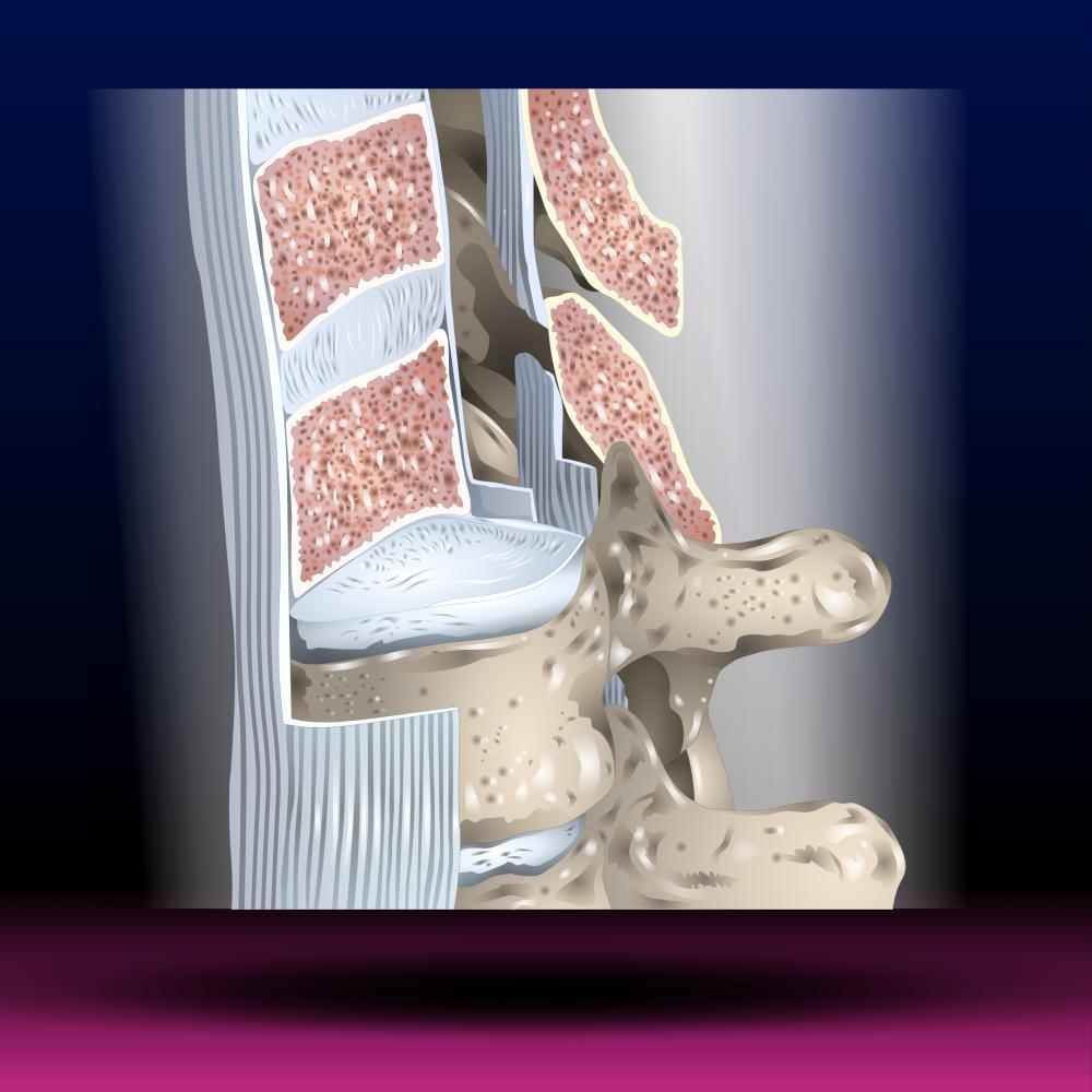 Is Stem Cell Therapy For Degenerative Disc Disease Effective?