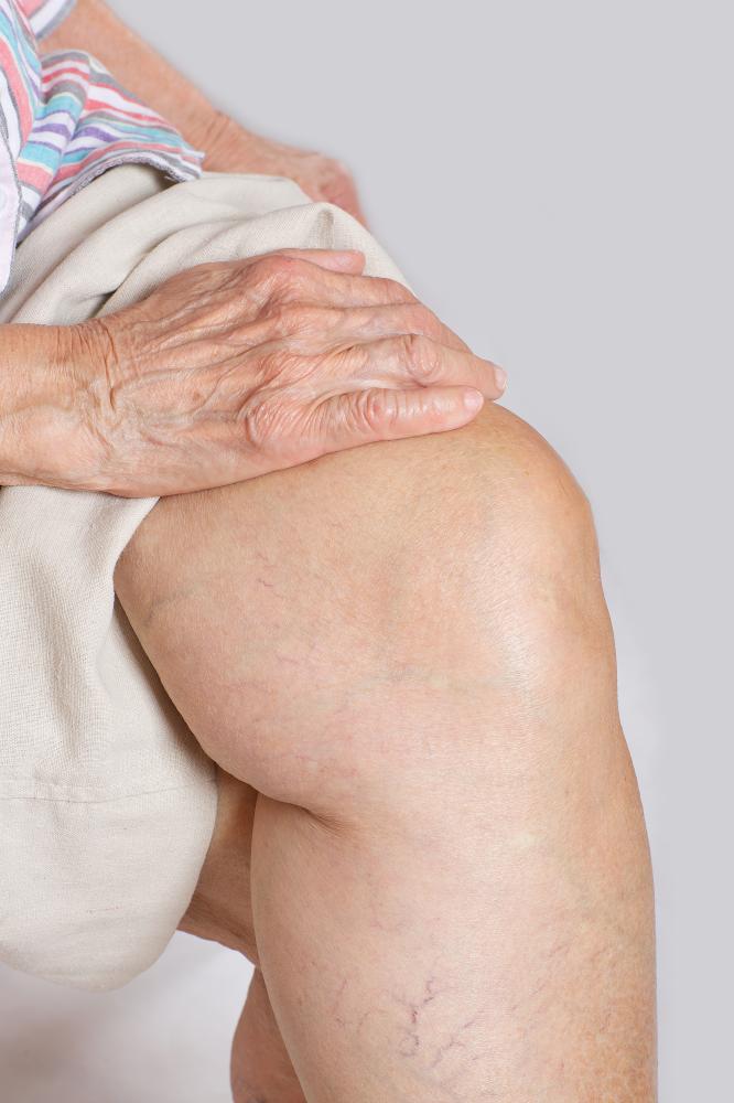 How Does Stem Cell Treatment Work for Arthritis?