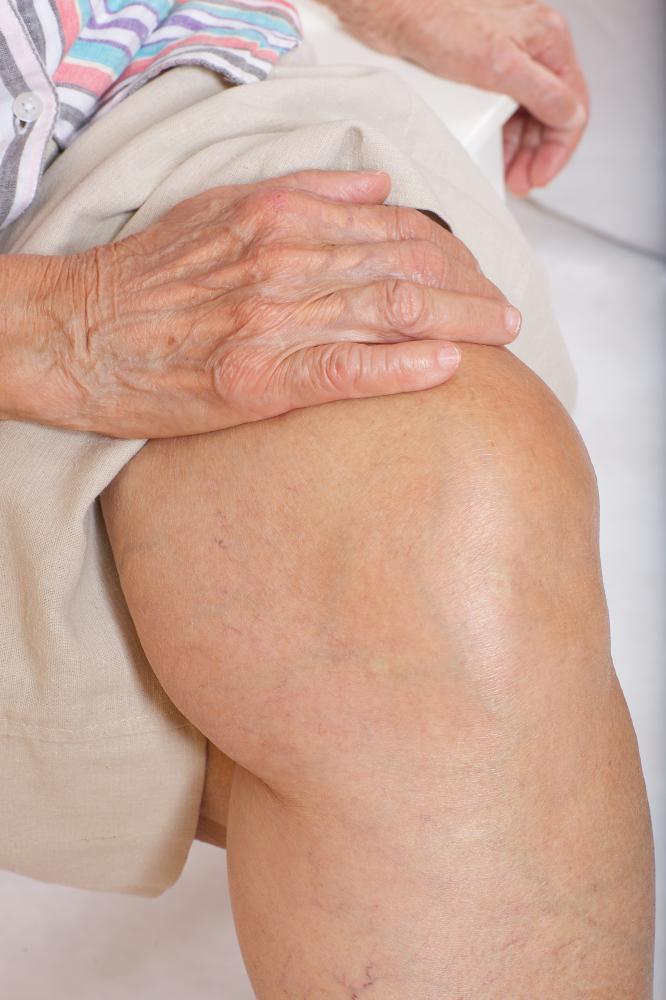 How Does Stem Cell Treatment for Arthritis Work in Palm Beach?