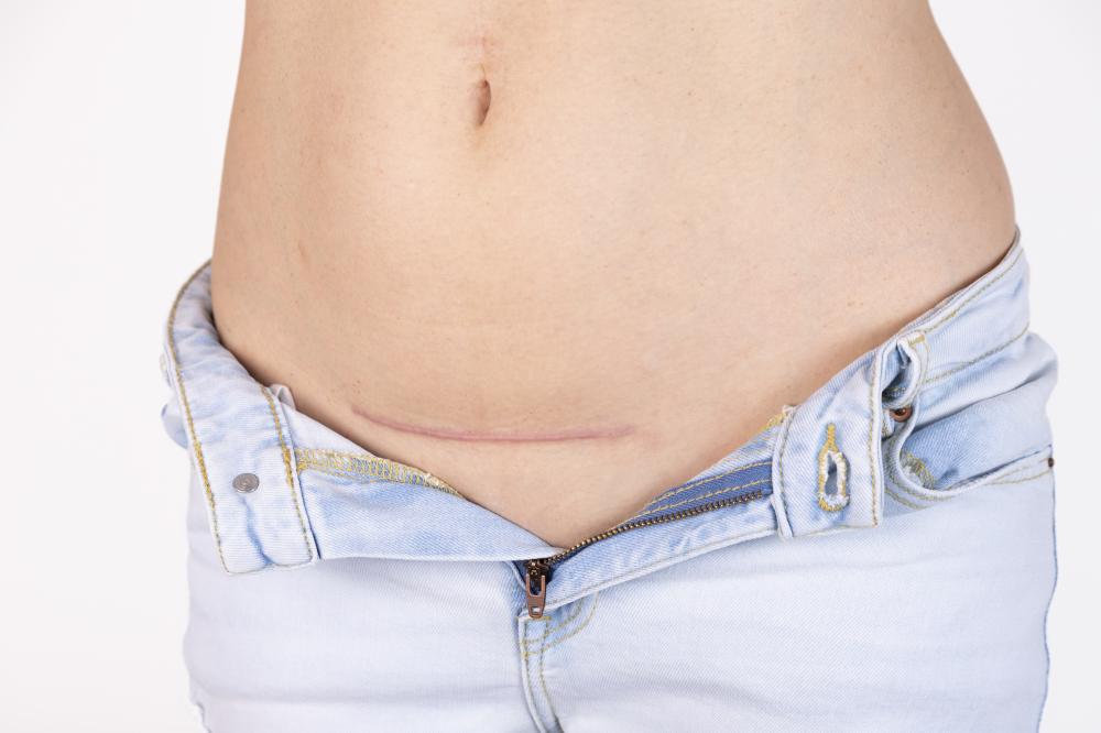 Choosing the Right Clinic for Your Tummy Tuck in Toronto