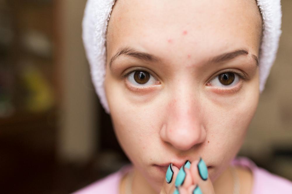 Understanding Acne Scars