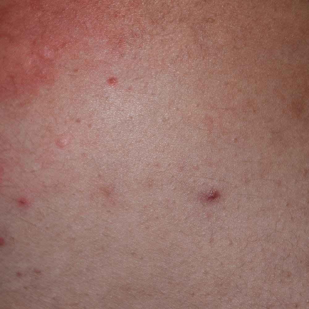 What Qualifies as a Melbourne Squamous Cell Dermatologist Emergency?