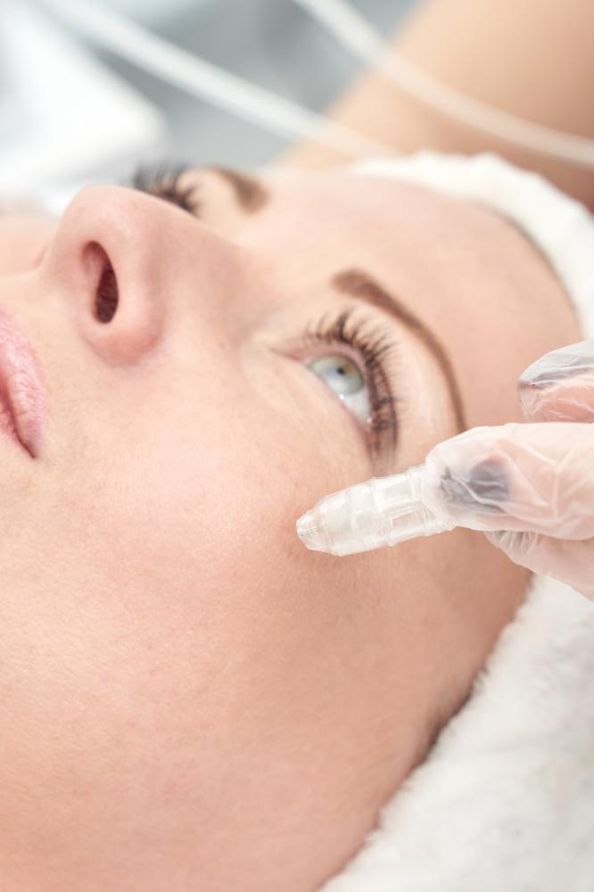 How Does Microneedling Stack Up?