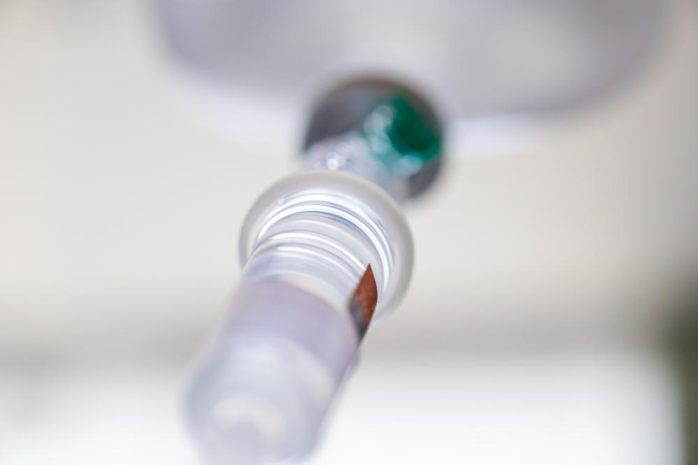 What is the Ketamine Infusion Process?