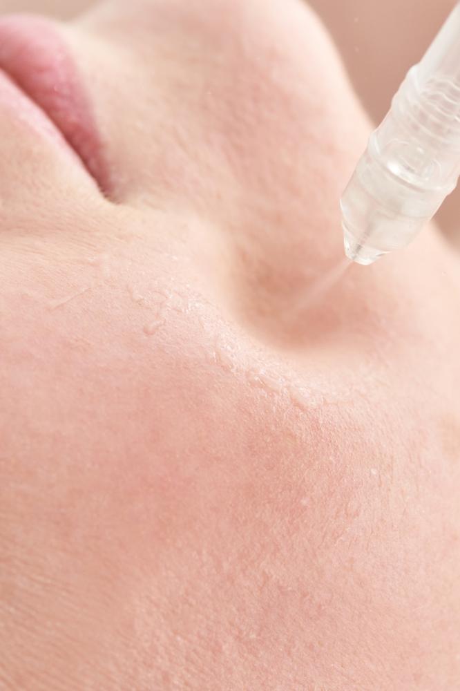 How Does Morpheus8 Microneedling Work?