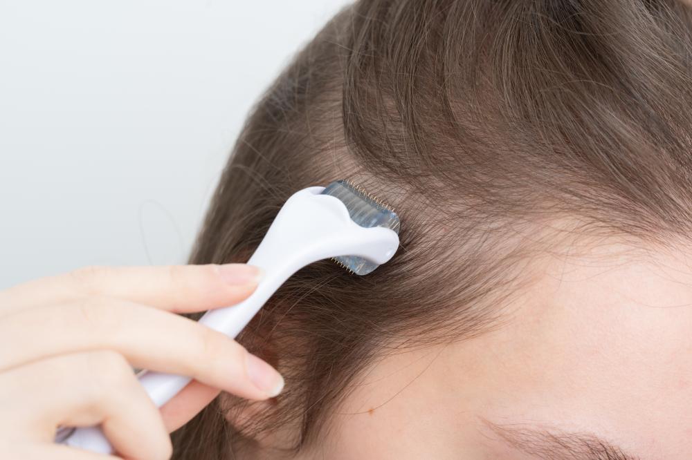 How is the Microneedling Procedure for Hair Loss Done?