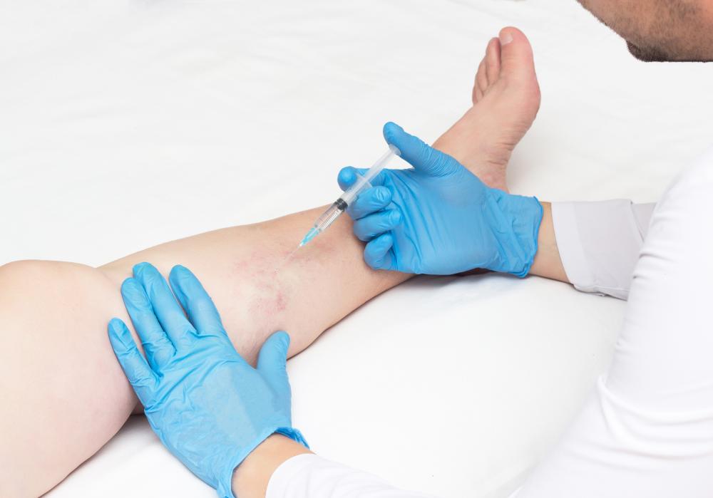 Why Choose Sclerotherapy?